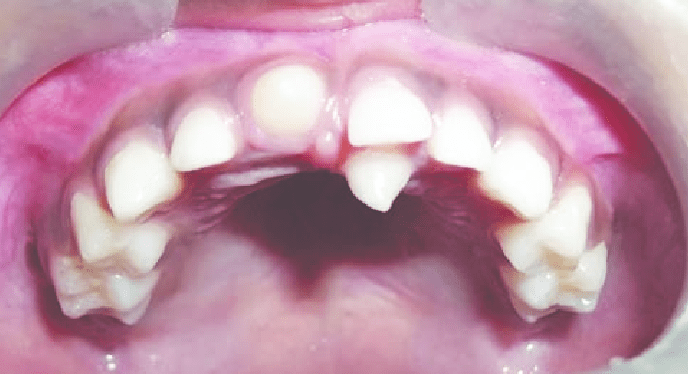 در آوردن دندان