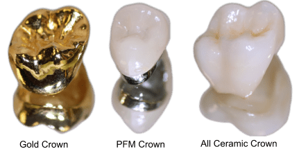 روکش دندان و مزایا و معایب آن 6 img22