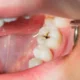 روش توقف و درمان پوسیدگی دندان